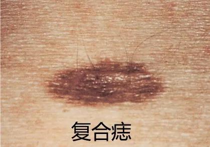 痣用点么,痣能点么