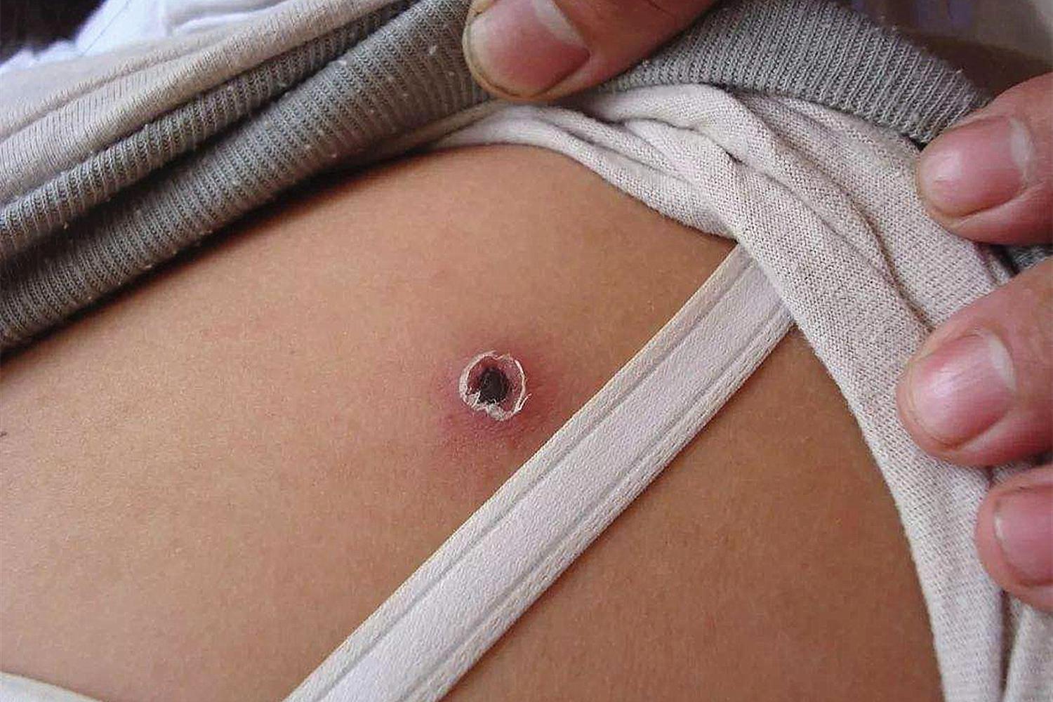 孩子被虫咬了发烧怎么办,小孩被恙虫咬会死吗