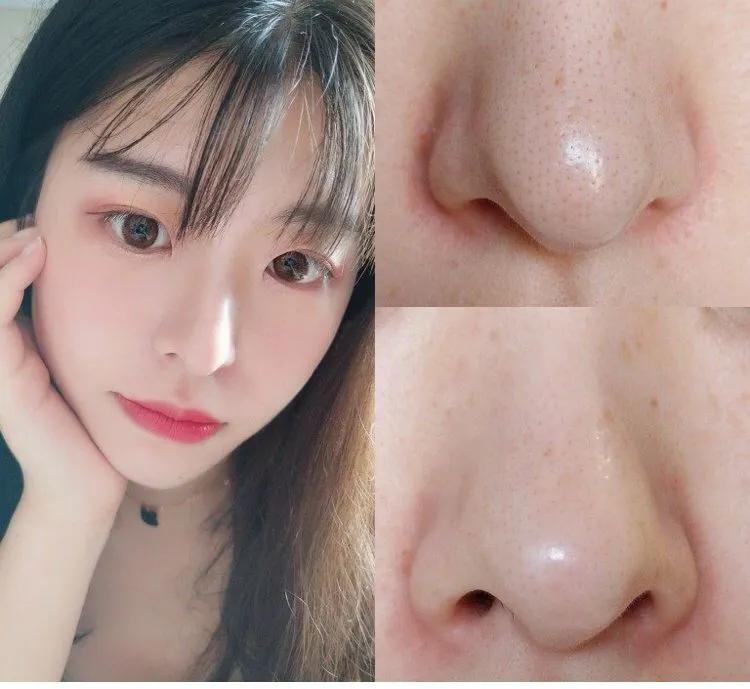 黑头闭口连根拔起,黑头粉刺连根拔起留坑