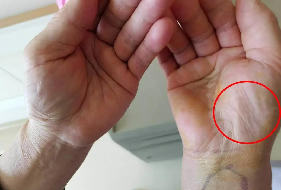 女子出现手麻,拖延1年后就医,手掌这地方已“瘪”掉!年轻人易中招