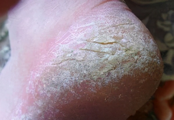 脚气为什么反复发作就是治不好,脚气总是治不好怎么回事