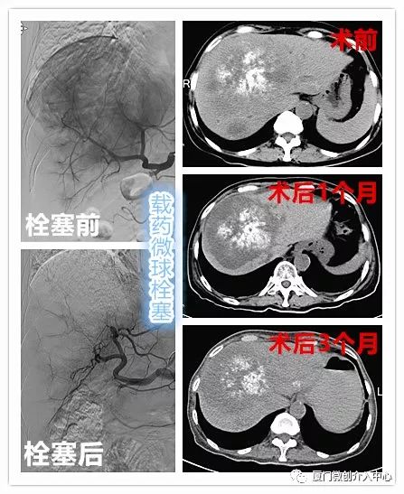栓塞介入能治疗肝转移瘤吗,结肠癌肝转移介入栓塞治疗