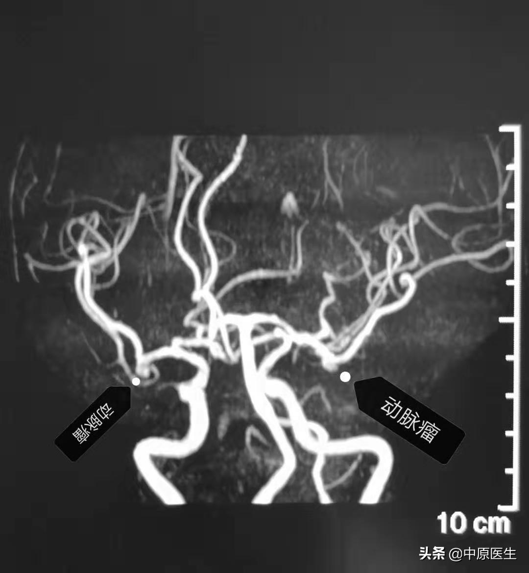 大脑双侧动脉瘤,发现脑内有两个瘤医生说不管