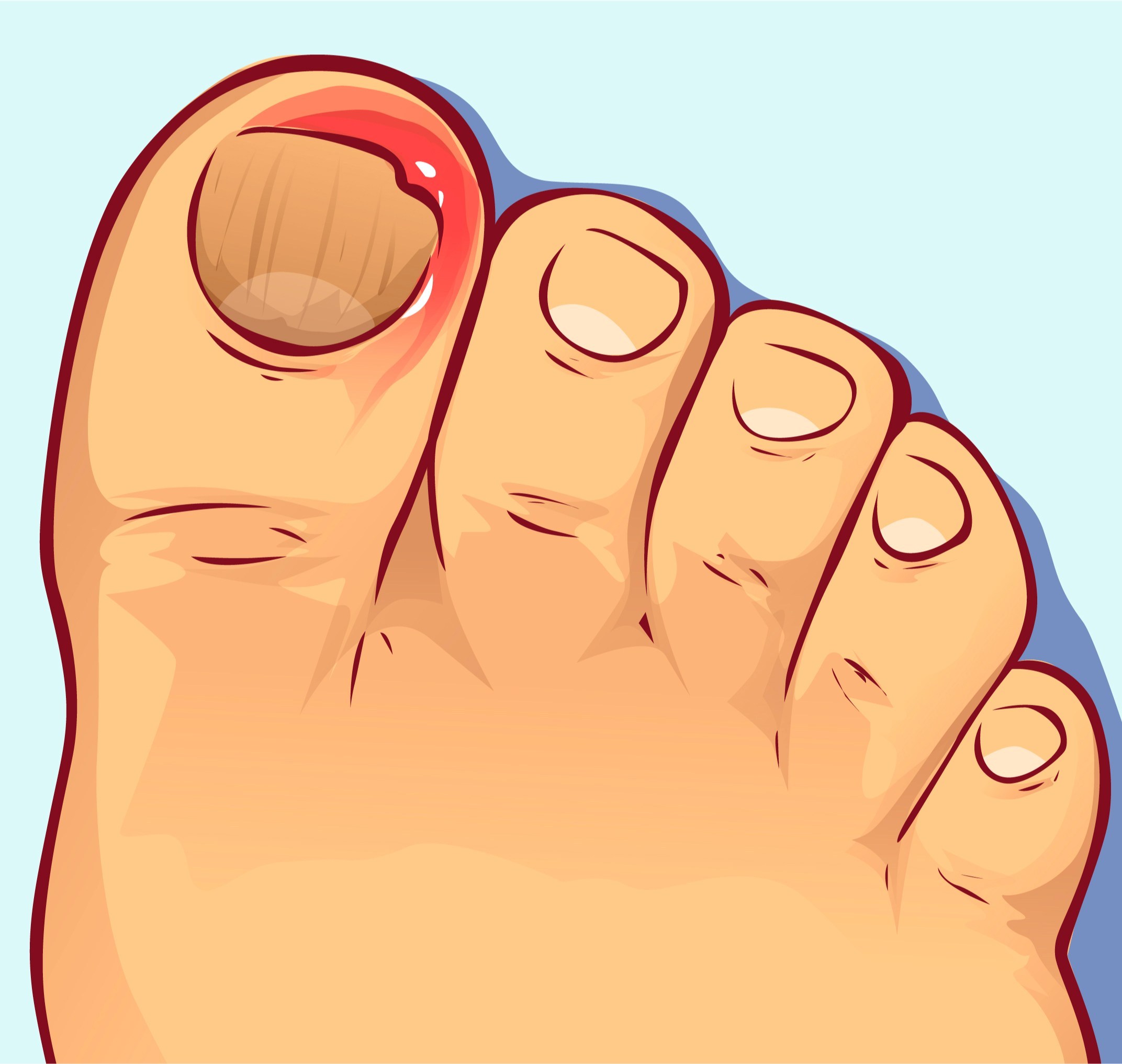 反复发作的甲沟炎应考虑什么疾病,甲沟炎注意事项及禁忌