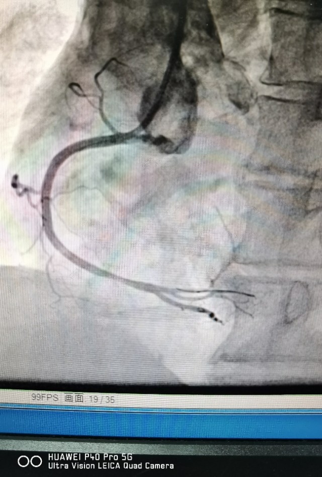 信阳市中心医院心脏射频消融手术,信阳中心医院心血管科室怎样