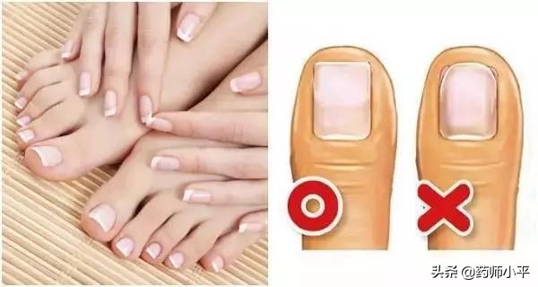 指甲老往肉里长一碰就痛怎么办,趾甲根部嵌甲怎么办