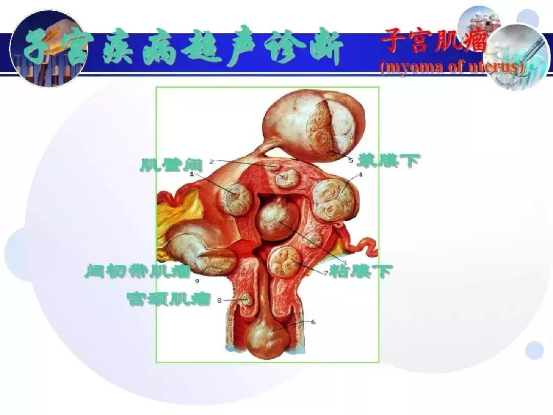 纯干货！子宫及附件解剖和超声诊断
