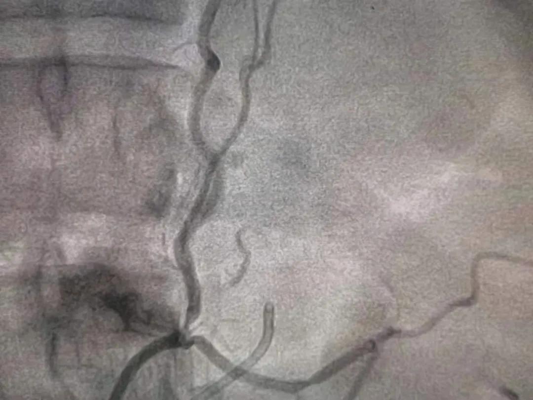 28岁男子患高血压8年未治,高血压患者瘫痪前兆