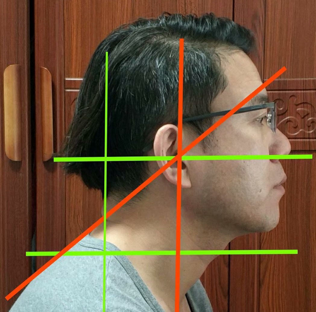 颈椎富贵包怎么做操可以缓解,颈椎突出一个包怎么快速恢复