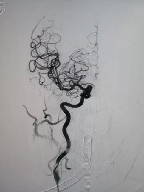 Tubridge®治疗多发性动脉瘤