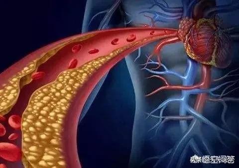 血脂异常药物治疗,血脂高药物治疗的指征