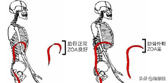 肋骨外翻矫正后还会外翻吗,一边肋骨外翻一边不外翻