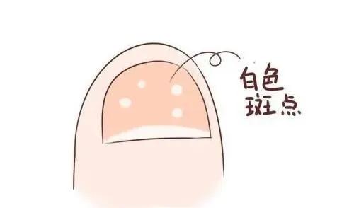 儿童指甲白斑坑洼不平是什么原因,8-12岁儿童指甲白斑是什么原因