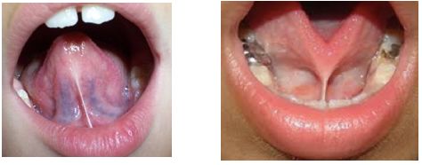 4岁舌系带过短要不要剪,什么是舌系带短图片