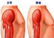 肩膀抬不起来怎么治疗,肩周炎抬不起来胳膊怎么办