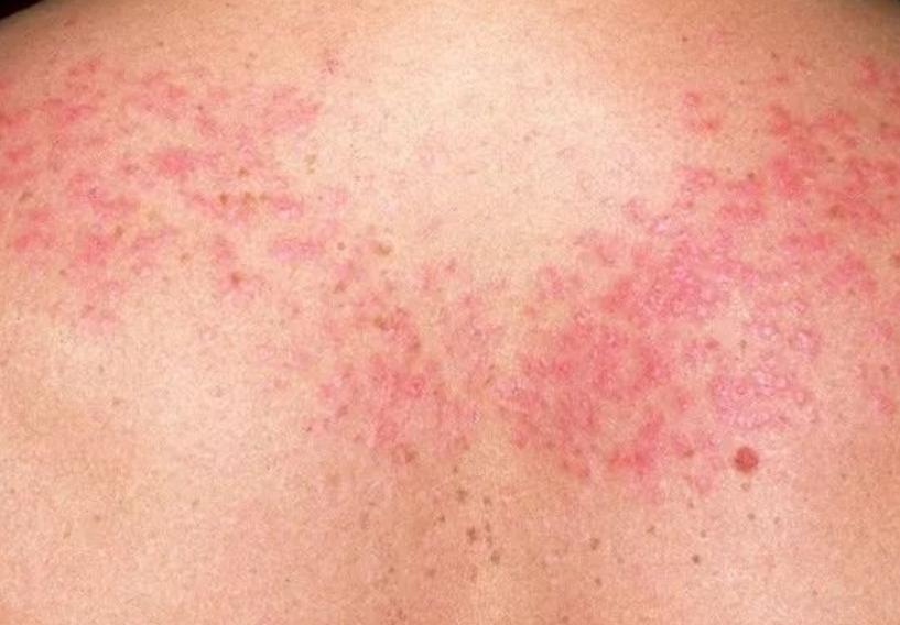 红斑狼疮为什么是不死的癌症,系统性红斑狼疮是不死的癌症吗