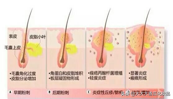 30岁后背长痘是什么原因,30岁脖子上长痘怎么回事