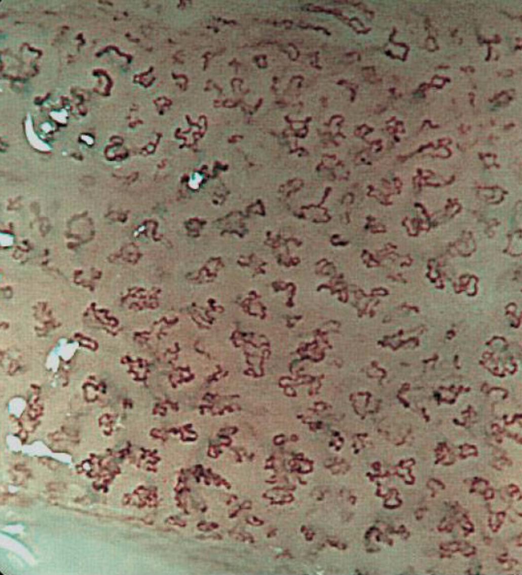 食管癌早期做胃镜能查到吗,食管癌通过胃镜可以检查出来吗