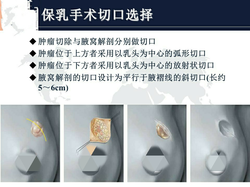乳腺癌指南2024版,乳腺癌指南有哪几个