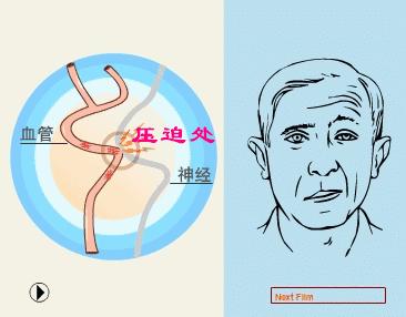 面瘫面肌痉挛区别,面瘫面肌痉挛和神经跳动