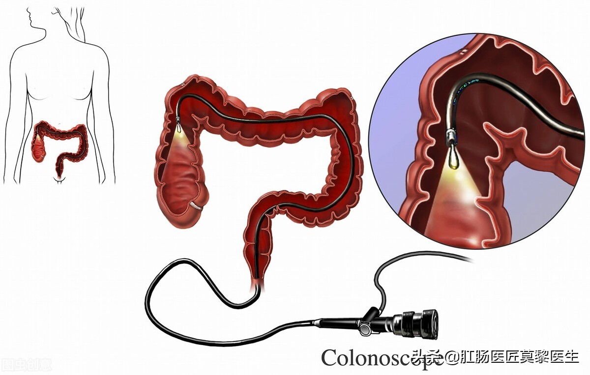 为什么胃肠息肉切除后容易复发,肠道息肉切除后还会复发吗