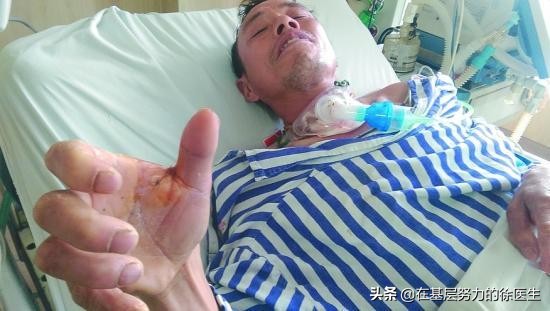 破伤风多久犯病,破伤风的潜伏期