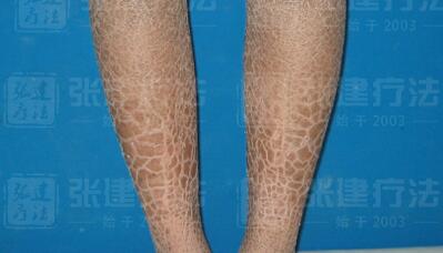 鱼鳞病症状与治疗方法,鱼鳞病的病因及症状