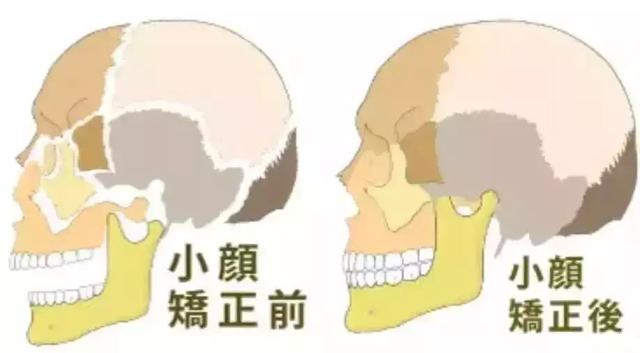 日式小颜整骨需要具备什么,日式小颜整骨术可以把额头变宽吗