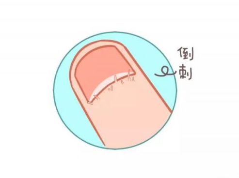 手指倒刺甲沟炎的症状及图片,手指甲沟炎是不是异物引起的