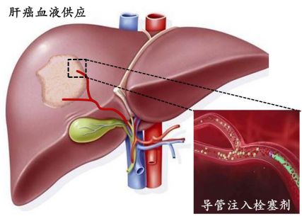 举例科普|介入能治疗哪些疾病?