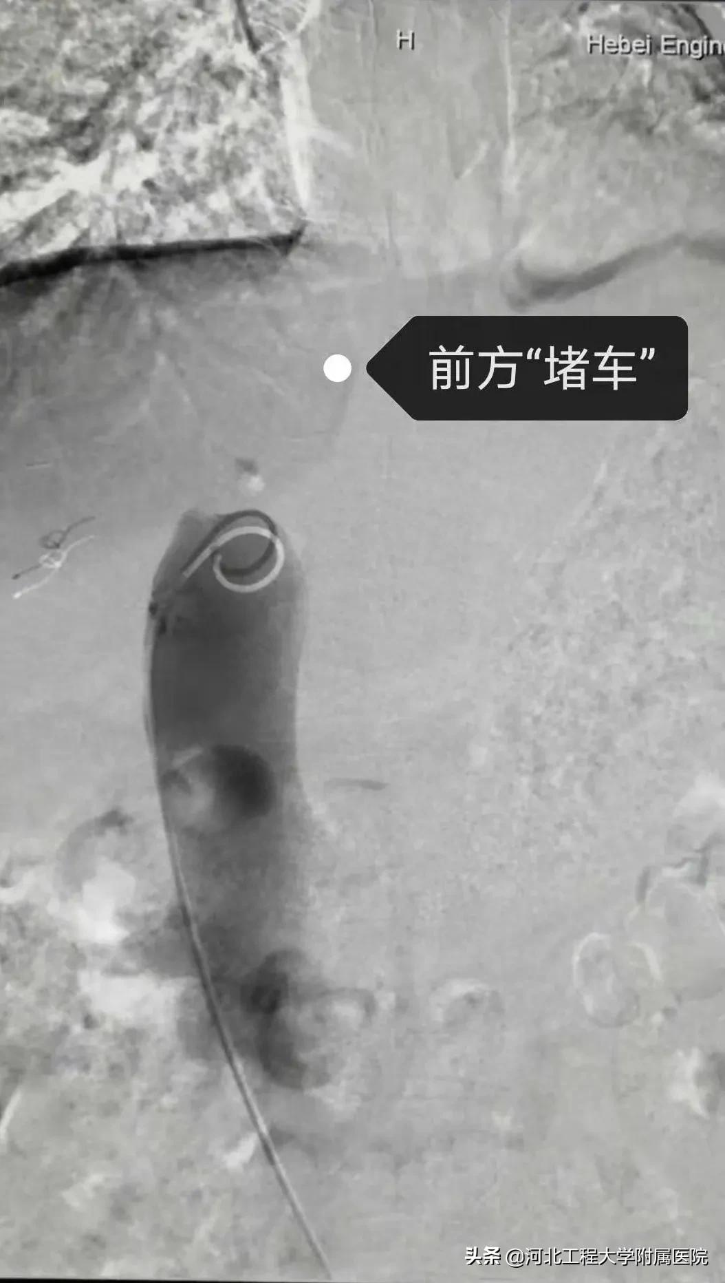 河北工程大学附属医院多学科诊疗,河北省布加氏综合征