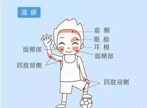 湿疹反复怎么根除吃中药,湿疹家庭自我治疗