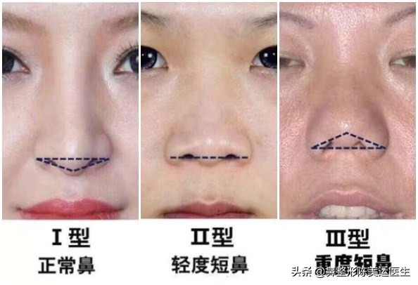 短塌鼻子可以做成直鼻吗,塌鼻子怎么能变成尖鼻子