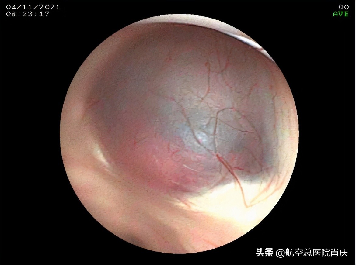 鞍上池蛛网膜囊肿手术费用,鞍上池蛛网膜囊肿影响智力吗
