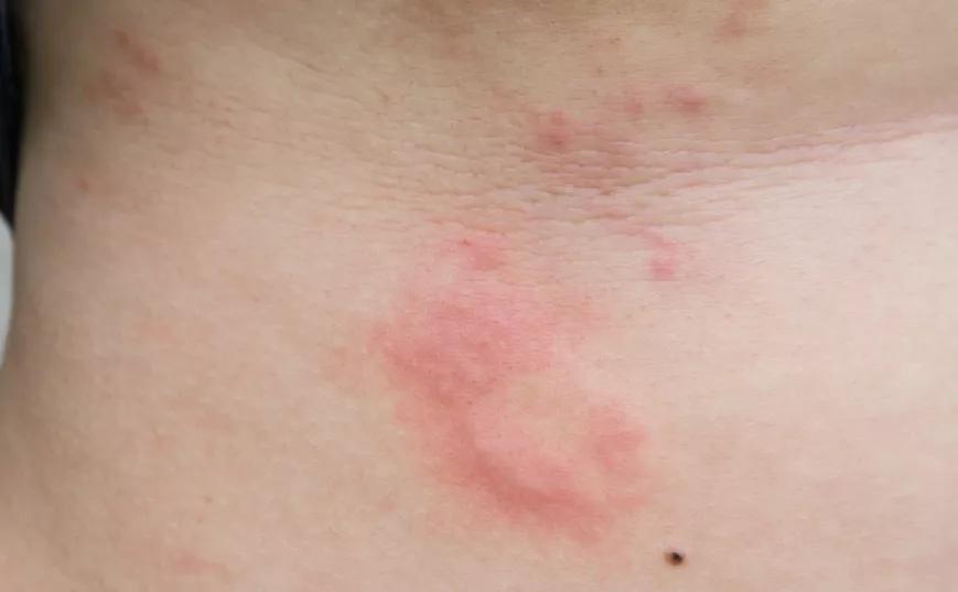 皮肤病反反复复要如何调理,皮肤病反反复复中药如何治疗