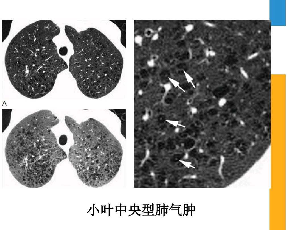 预防肺气肿的疫苗,肺气肿应该怎样预防