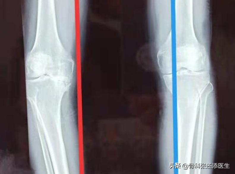 膝骨关节炎减轻疼痛的方法,膝盖骨关节炎怎么治疗效果最好