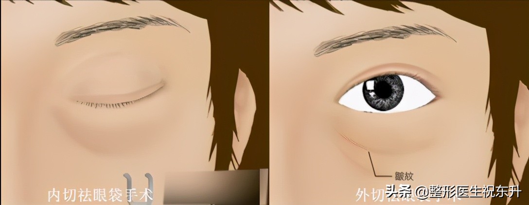 想做眼袋手术做哪种好,去眼袋手术会有疤痕吗