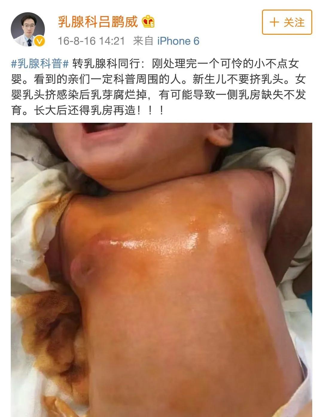 女婴挤乳腺后果,新生女婴被挤乳核了怎么办