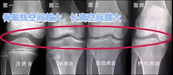 17岁女孩只有155cm，报考舞蹈专业受限！发现这两个红灯，多长5cm