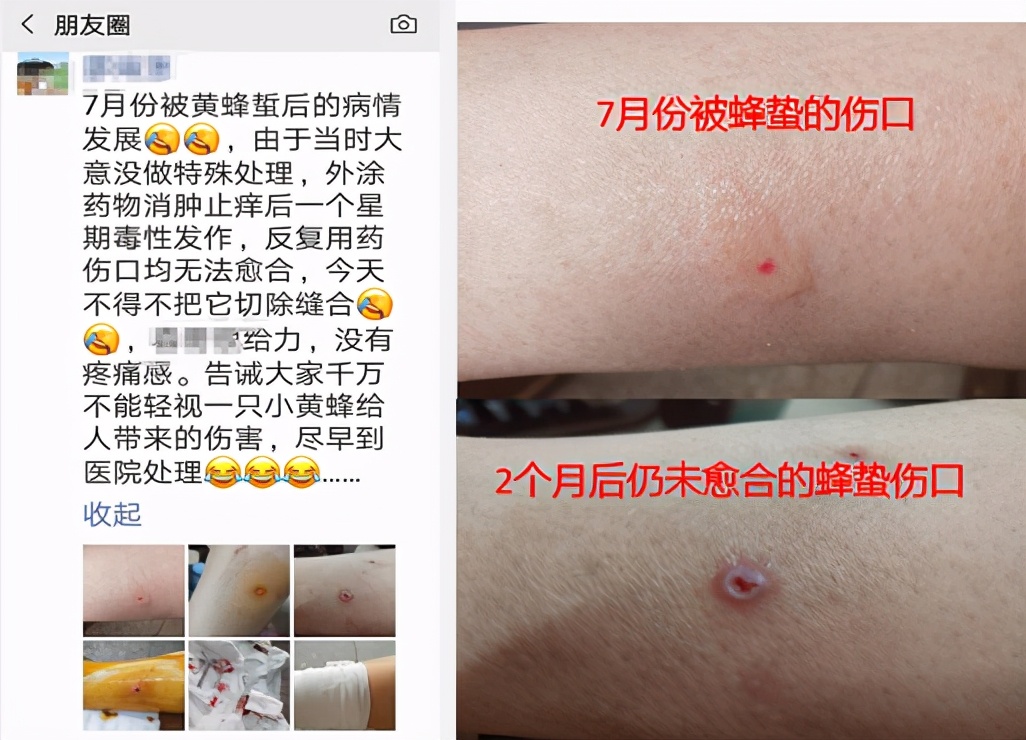 蜂蛰之后怎么处理,蜂蛰后多长时间能消肿