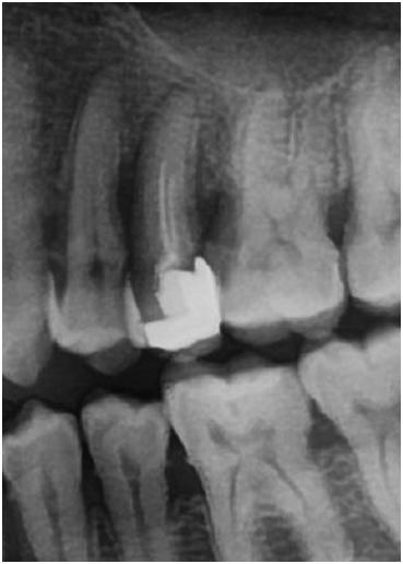 你们做根管治疗花了多少钱,根管治疗做了真的有用吗
