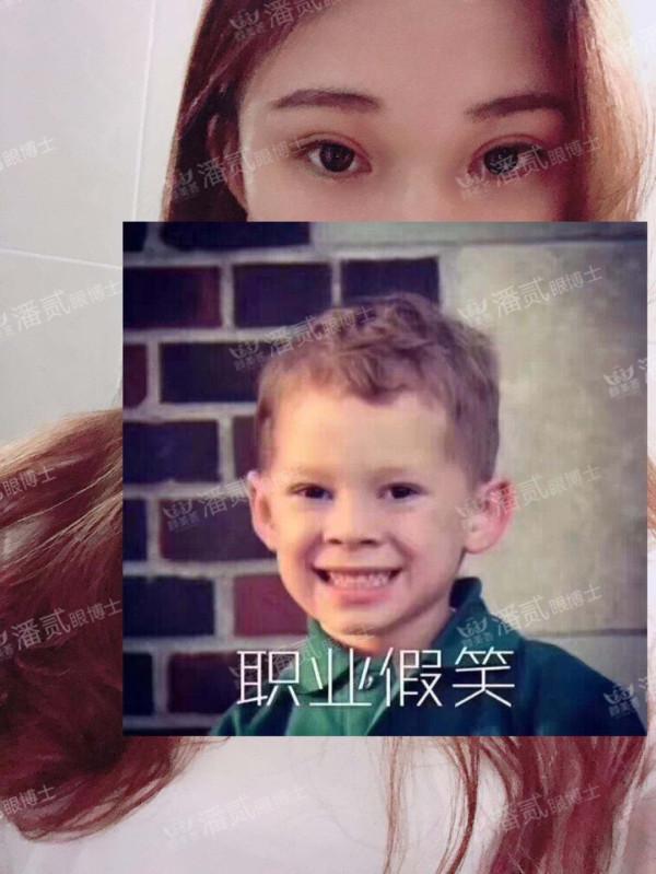 什么样的肿眼泡适合全切,什么样的肿眼泡不用动提肌