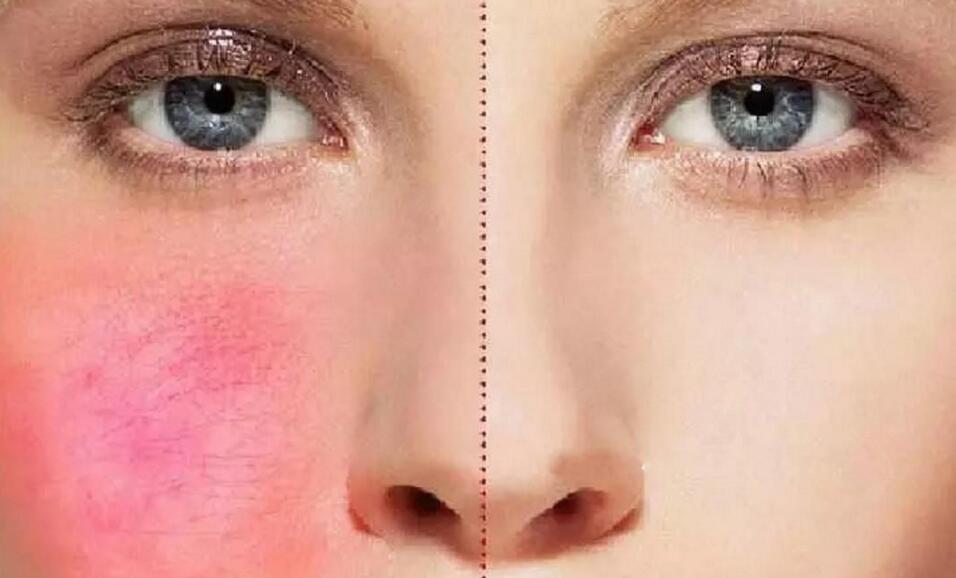 天生脸部泛红怎么改善红血丝特多,血丝斑点如何祛除