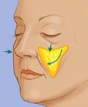 法令纹和苹果肌下垂哪个更显老,脸上肉多但是下垂