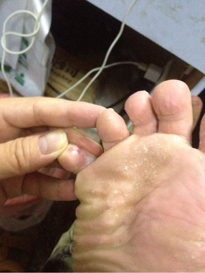 脚气反复发作其实是防治方法不对,脚气在治疗上的误区有哪些