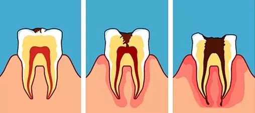 上牙龈上火突出一个鼓包,牙龈肿胀鼓包上火了吗