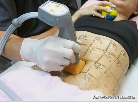 热玛吉有必要做么,热玛吉适用于什么人群