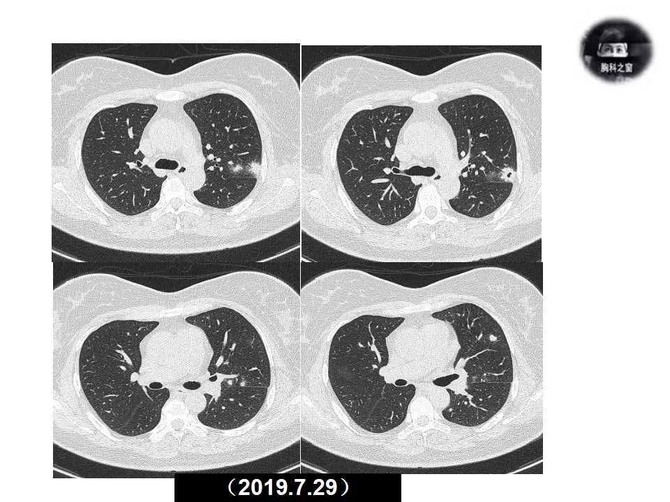 双肺多发结节是肺癌的征兆吗,双肺多发结节灶