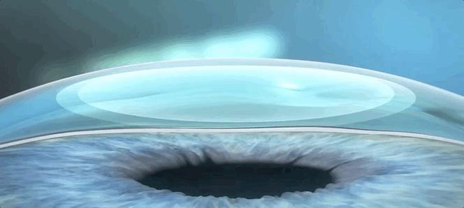 激光治疗近视什么原理,激光矫正是什么原理